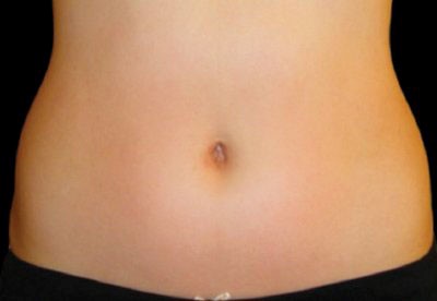 Edgbaston-Wellness-Medispa-Bespoke-Fat-Reduction_after