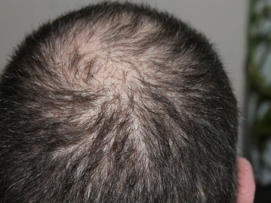 Edgbaston-Wellness-Medispa-PRP-hair-loss-restoration