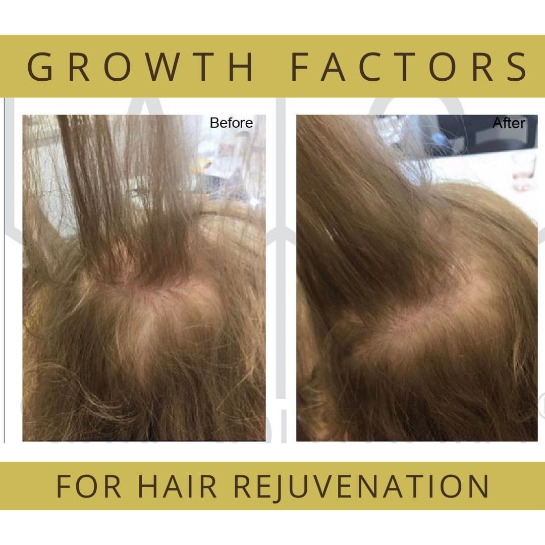 PRP Hair Loss Restoration Treatment at our Birmingham Clinic