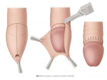Circumcision Procedure