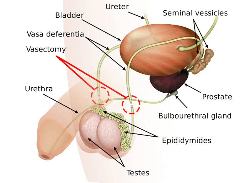 vasectomy process